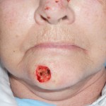 Squamous Cell Carcinoma