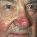 Rosacea