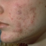 Laser Acne Treatment