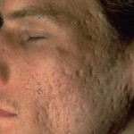Scars from acne
