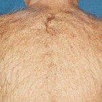 Body Hair - Before Treatment