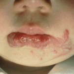 Hemangioma - Growth type
