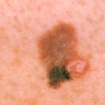 Melanoma