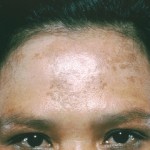 Melasma