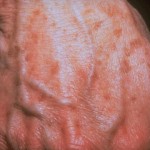 Pigmentary disorder