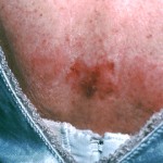 Superficial basal cell carcinoma
