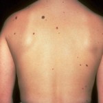 Mole Removal