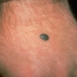 Birthmarks