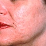 Skin Tightening