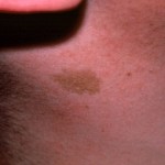 Birthmark - Before Laser Treatment