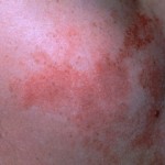 Port Wine Stains - Before Treatment