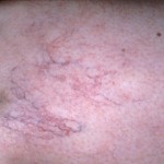 Leg Vein Treatment
