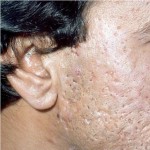 Acne Scars
