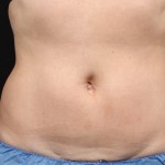 Body Contouring